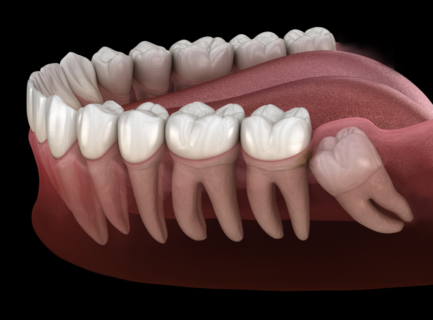 Https://Assets.Tina.Io/9dd711a7 3830 4c2d Af87 51e6bbd3afd9/Images/Services/Wisdom Tooth Extraction/Wisdom Tooth Mold.Jpg