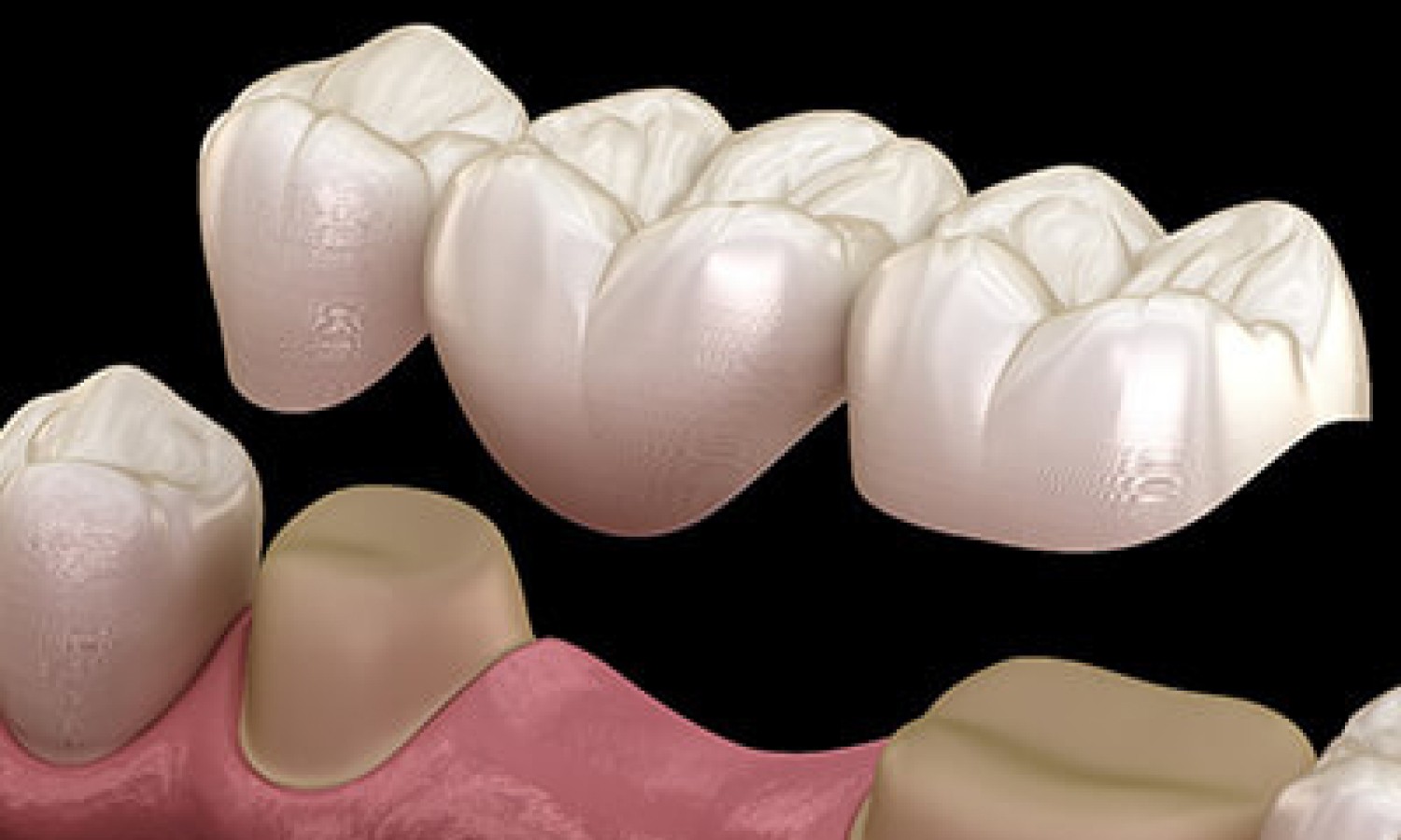 3d graphic of dental mold